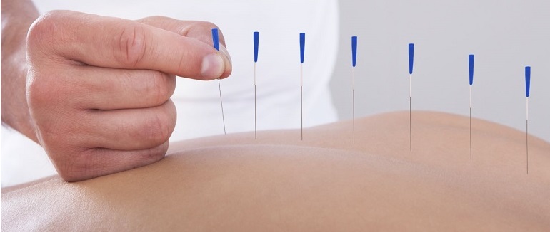 Acupuncture Clinic in Ancaster 