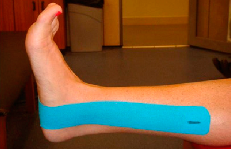 Kinesio Taping