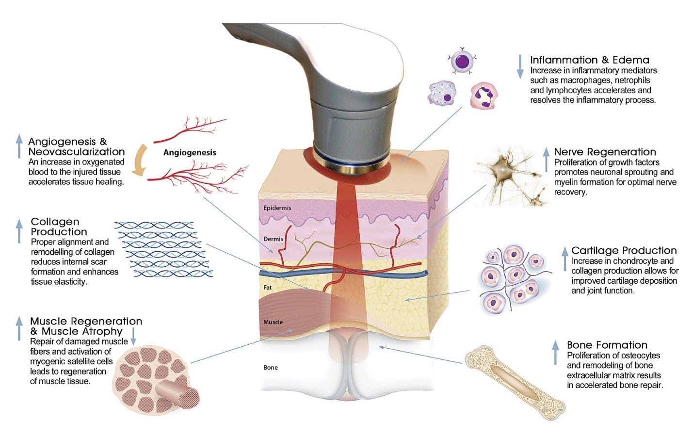  Laser Therapy Diagram